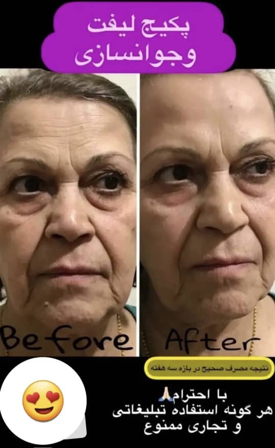 بهترین کرم ضدپیری گاتیو با اثر فوری و واقعی