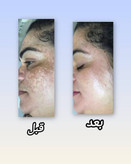 تصویرقبل وبعددرمان بارزماری