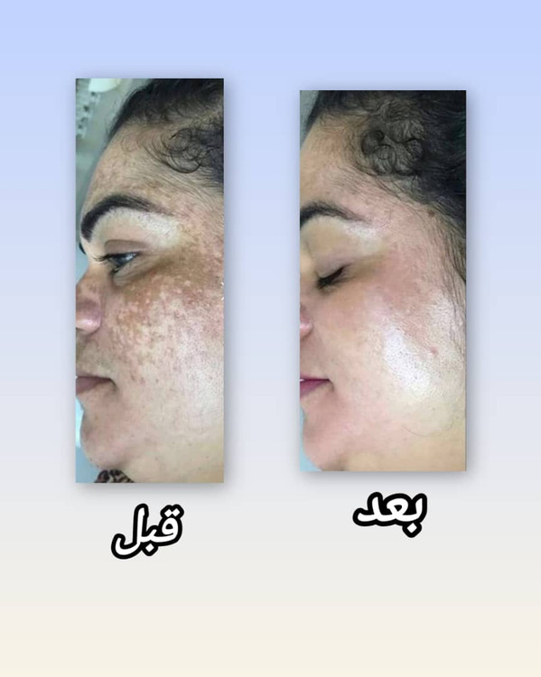 تصویرقبل وبعددرمان بارزماری